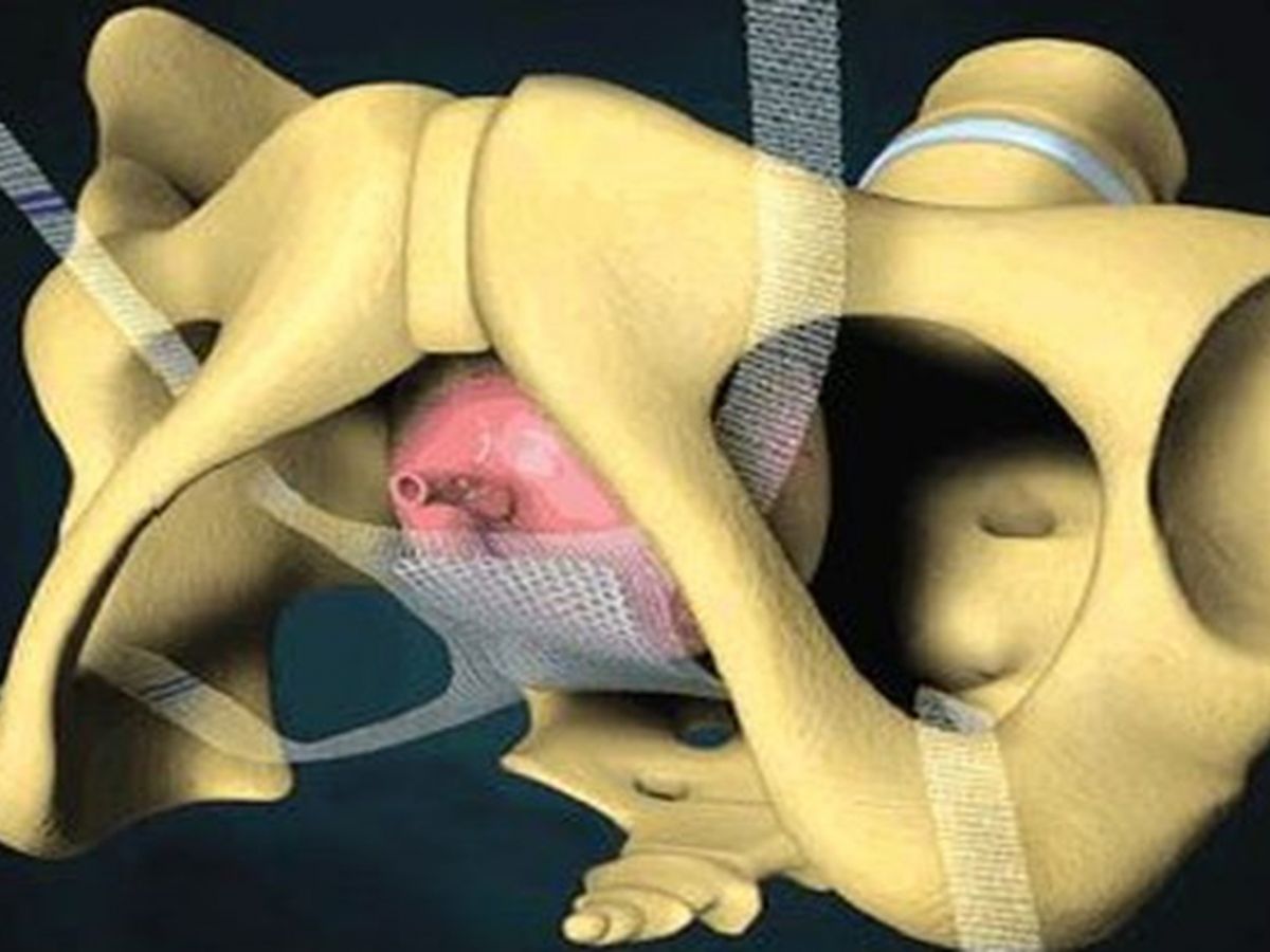 Seksualna funkcija bolja s laparoskopskim mrežicama u terapiji cistocele