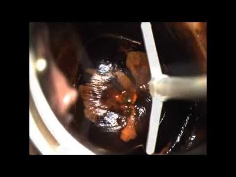 LETZ zahvat – liječenje promjena vrata maternice