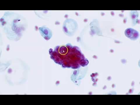 Endometrijske stanice u PAPA testu