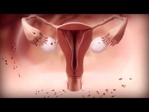Duboka endometrioza: IVF prije operacije ili nakon nje?