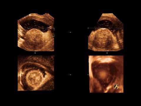 Ultrazvučna dijagnostika mioma maternice