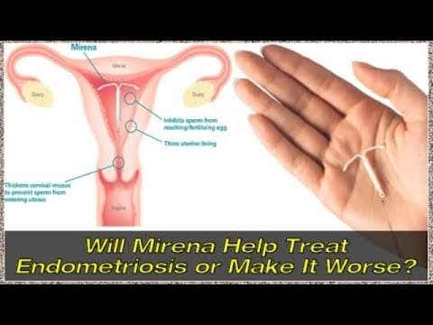 Hormonska spirala nakon operacije smanjuje povratak simptoma endometrioze