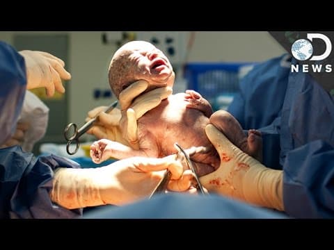 Elektivni carski rez i rizik za astmu u djetinjstvu