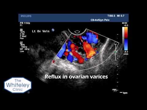 Color dopler u ginekologiji